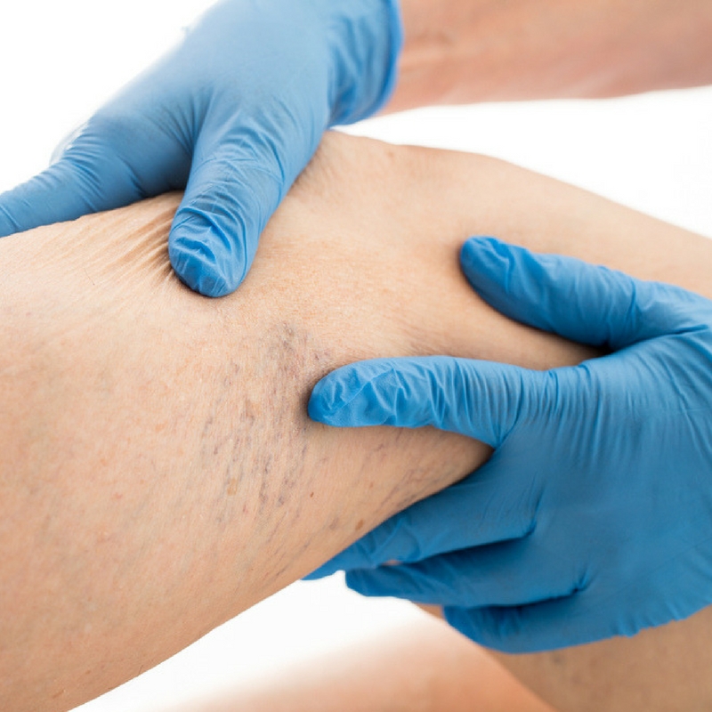 The Top 12 Causes of Spider Veins and How to Treat Them | Vein KC