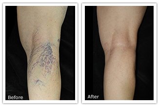 Spider Vein Photo Before and after spider vein treatment