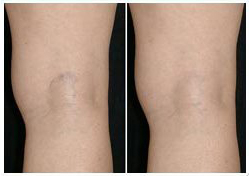 spider veins on back of leg before and after
