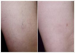 spider vein removal before and after