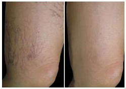 purple spider veins before and after treatment