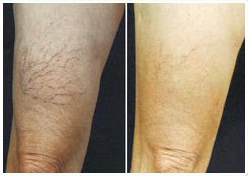spider vein treatment before and after