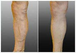 leg with varicose veins and result of treatment