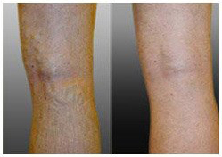 treatment results for varicose veins