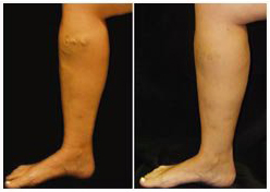 varicose veins close to knee before and after