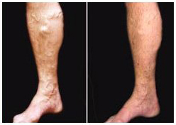 severe varicose veins on leg before and after