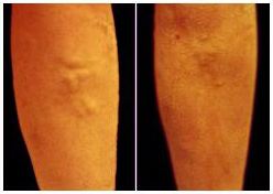 visible difference between pre and post vein treatment