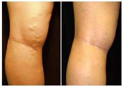 varicose veins on back of leg disappear after treatment