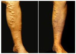 extreme varicose vein reduction after treatment