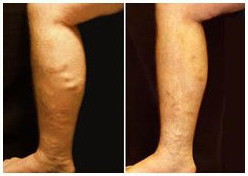 varicose veins on lower leg before and after