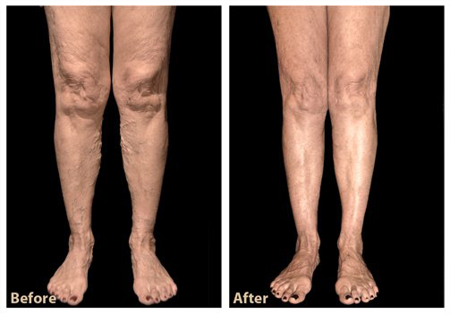 vein treatment before and after results