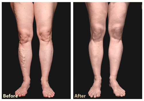 vein treatment on legs before and after
