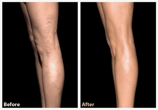 legs before and after vein treatment