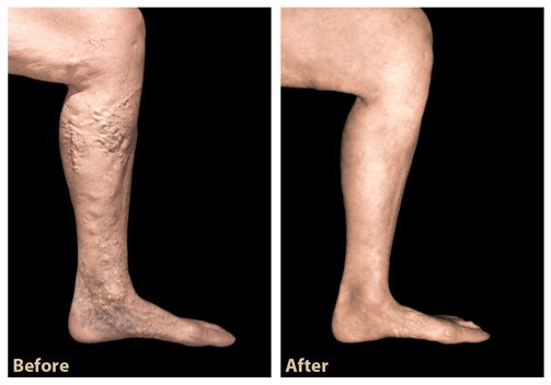 varicose veins before and after treatment