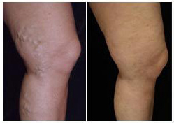 before and after leg vein treatment