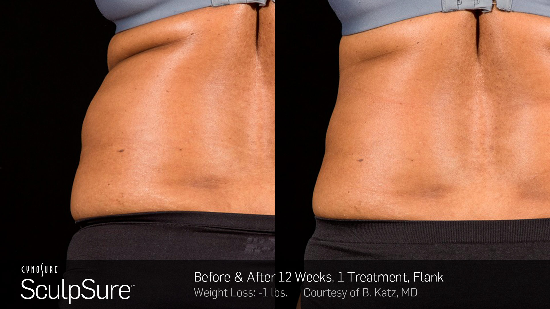 KC SculpSure treatment for sides and back