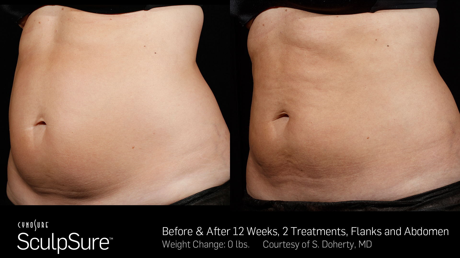 Sculpsure treatment in Overland Park, Before and After Photos