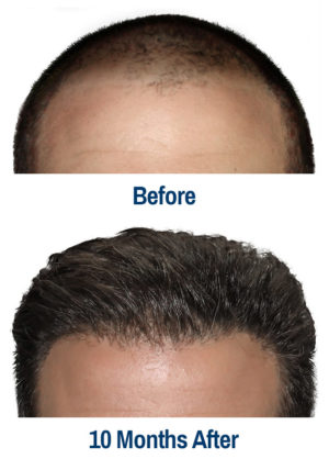 Kansas City hair restoration services