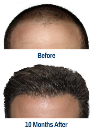 Before-After-1 Kansas City hair restoration services