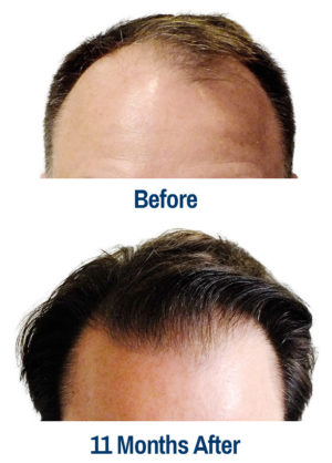 Before-After-2 Results of our hair transplant services in Kansas City