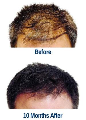 example of hair restoration with robotic hair transplants from AestheticKC