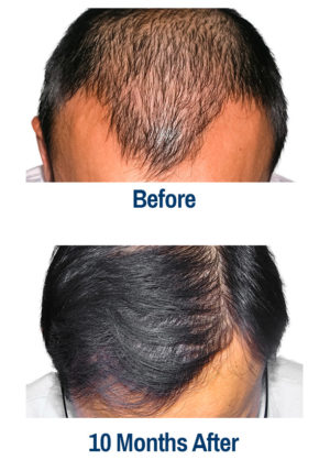 Kansas City hair transplants before and after