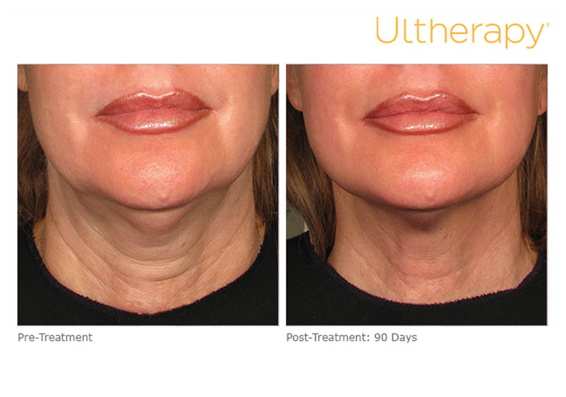 before and after ultherapy treatment