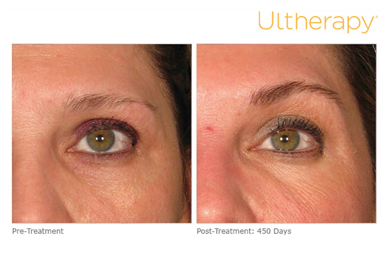 before and after of ultherapy procedure - 450 days