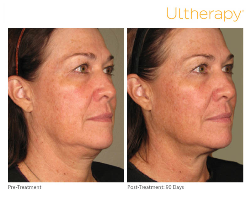 neck skin before and after ultherapy