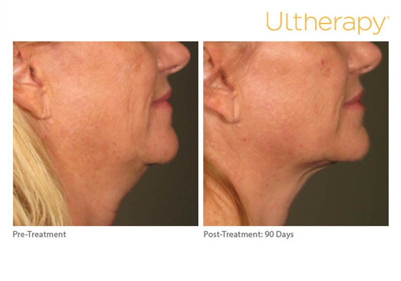 ultherapy treatment for neck - before and after