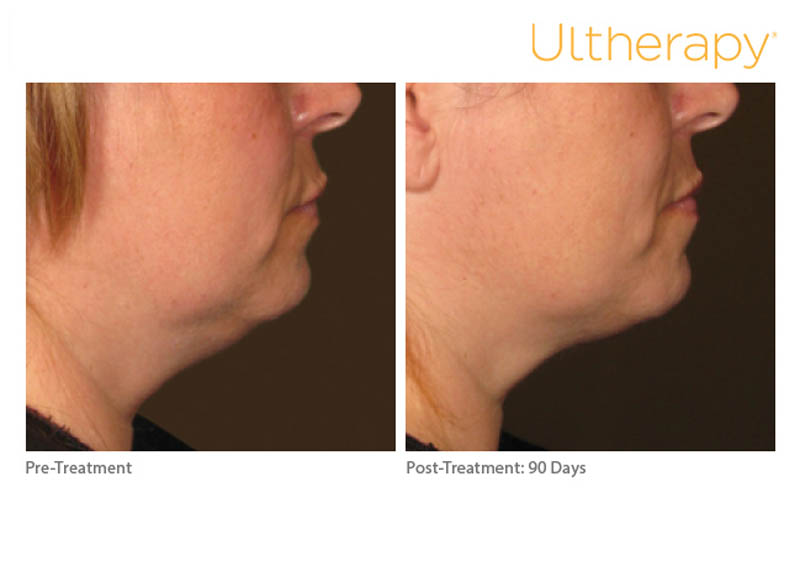 ultherapy before & 90 days after procedure