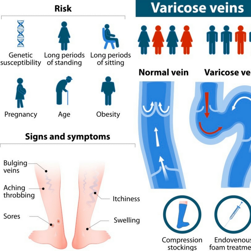 varicose-veins-infographic-kc-vein-clinic