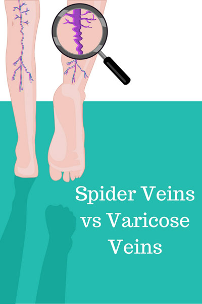 graphic showing difference between spider veins and varicose veins