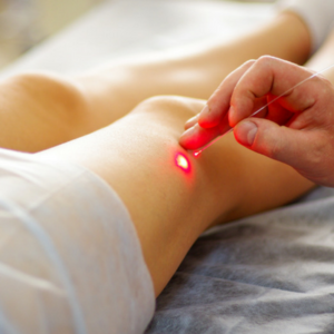 laser treatment for veins