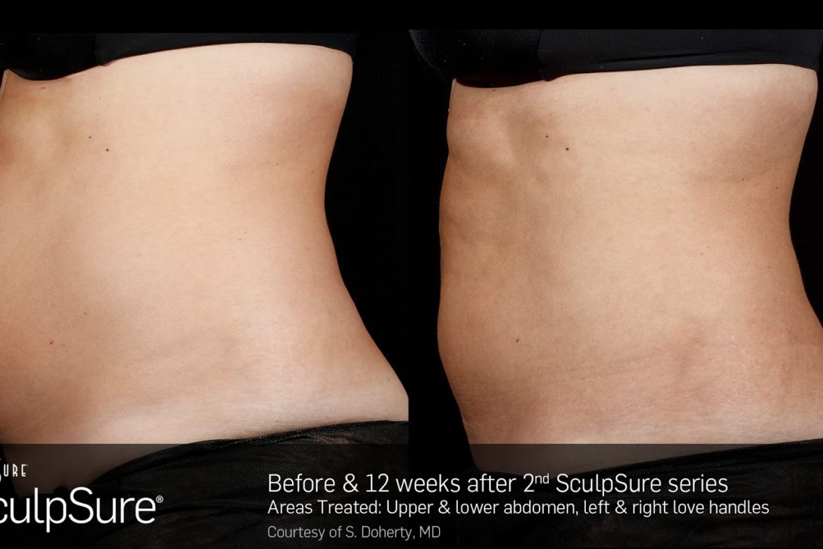 SculpSure Before & After Pics