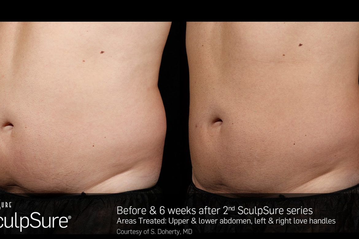 Sculpsure For Guys