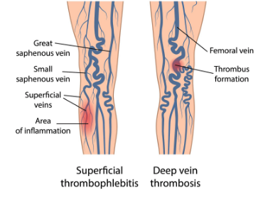 varicoza trombohihic