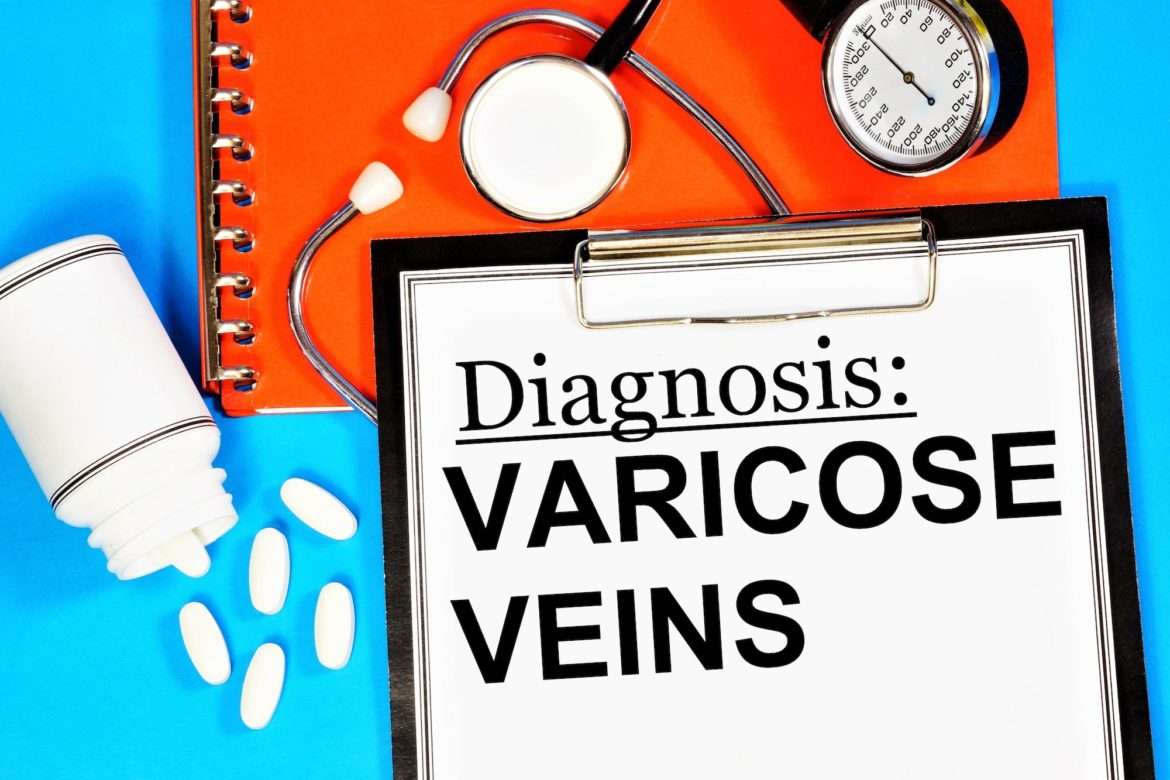 Varicose Vein Diagnosis