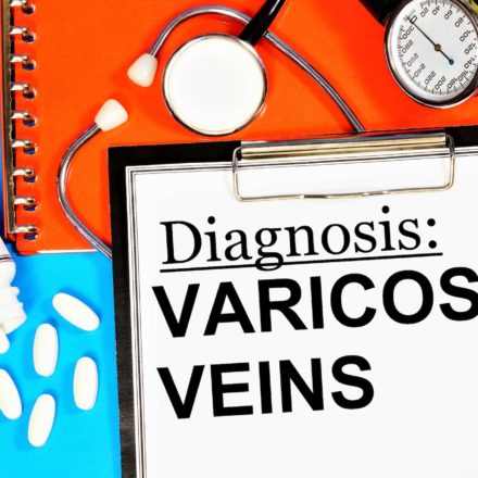 Varicose Vein Diagnosis